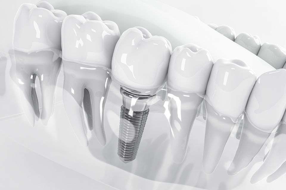 Dental Implants