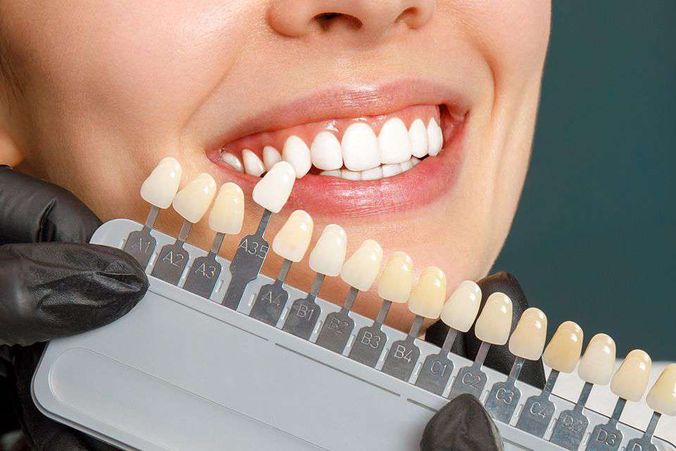 Porcelain Veneers – Emax
